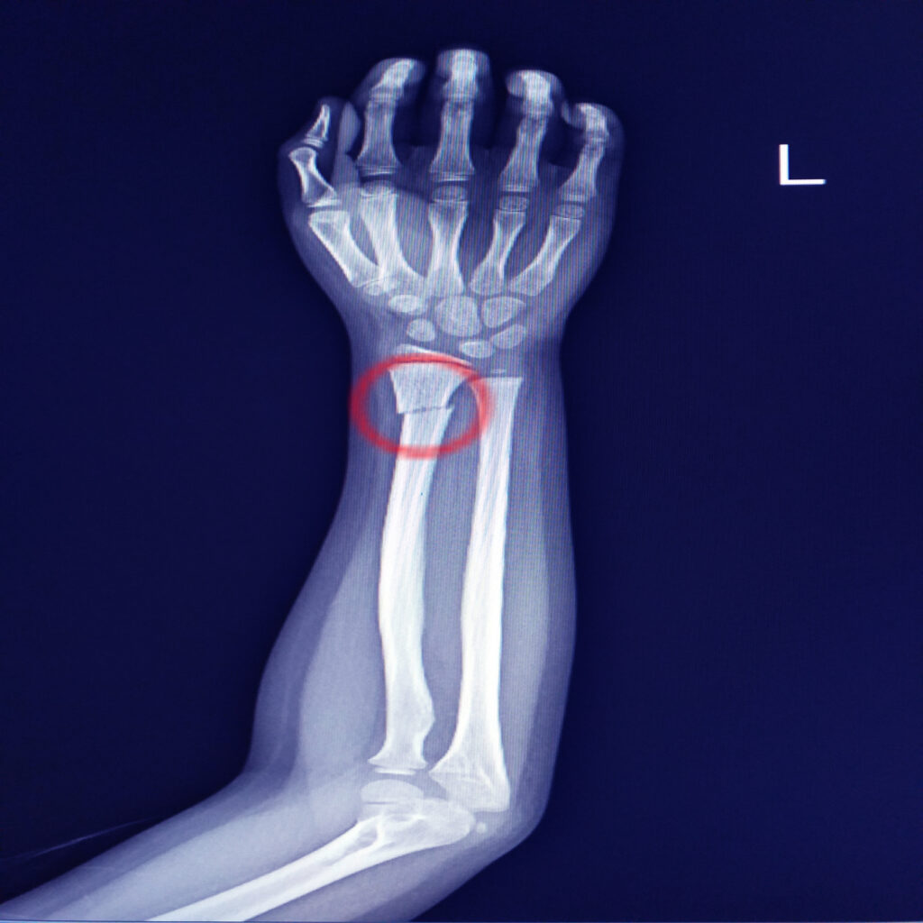 Radius Fracture