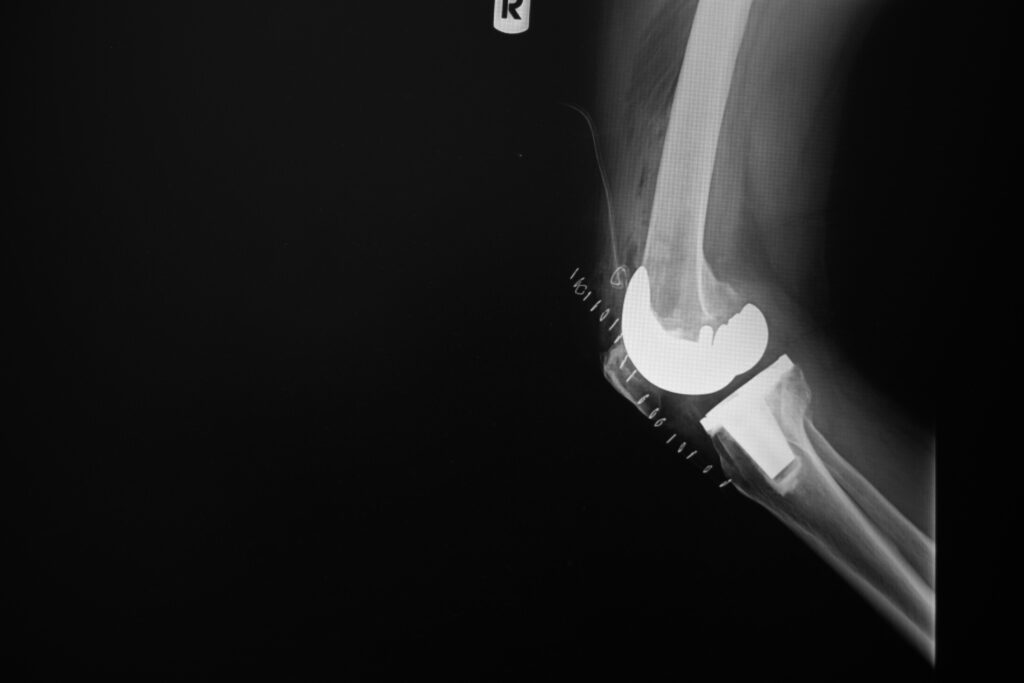 Knee Replacement - jrc