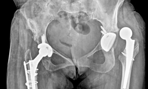 Pelviacetabular Surgery